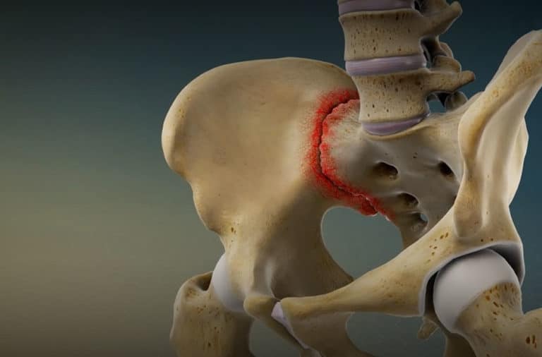 Sacroiliac (SI) Joint Pain Treatment - Axis Spine Clinic